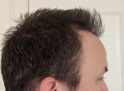 hair replacement st louis|About St. Louis Hair .